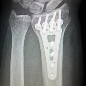 broken-arm x ray
